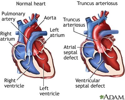 truncus arteriosus - Growing Your Baby : Growing Your Baby