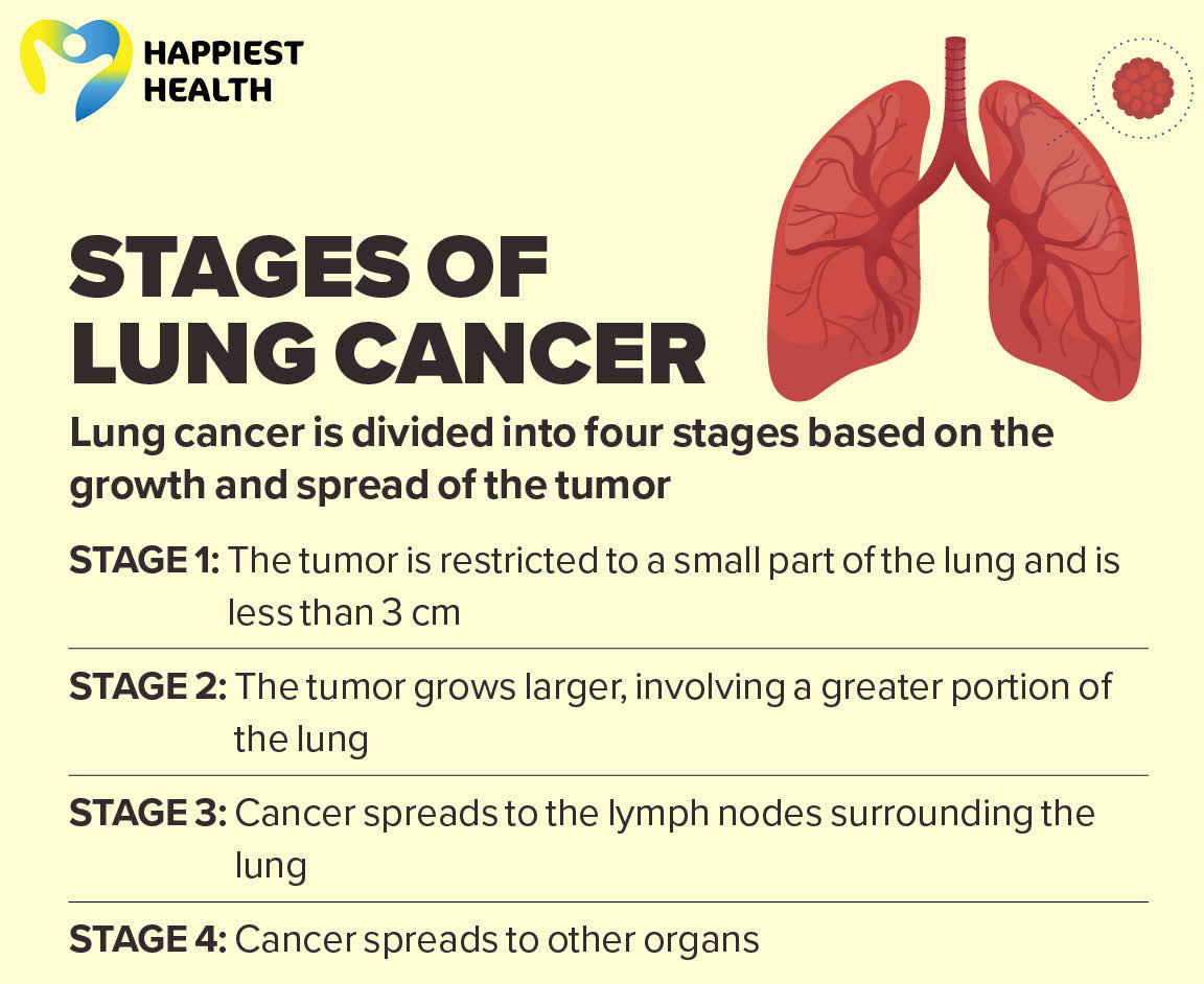 Lung cancer: When cells turn rogue Happiest Health