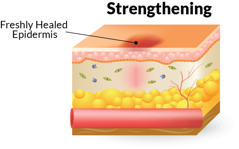 Infected Wound Healing Stages