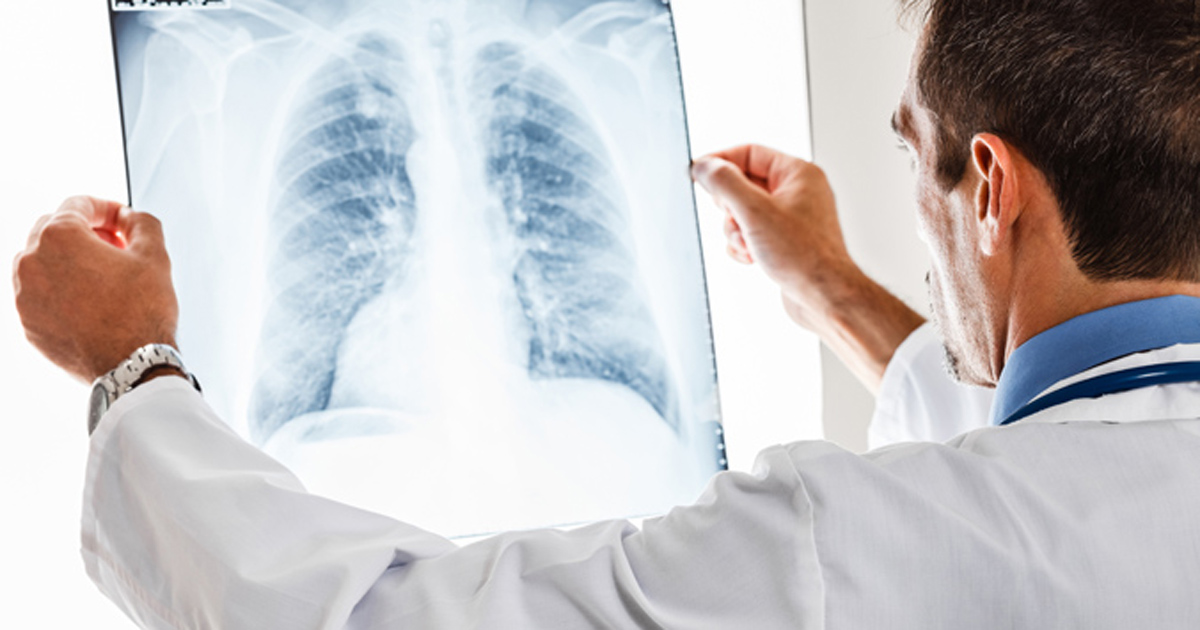 Durvalumab improves survival in limited-stage small cell lung cancer