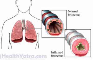 Asthma Child Definition, Causes, Symptoms, Complications and Cost ...