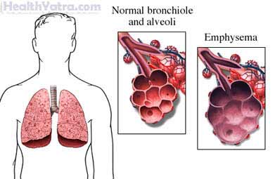 Emphysema Definition, Causes, Symptoms, Complications and Cost Surgery ...