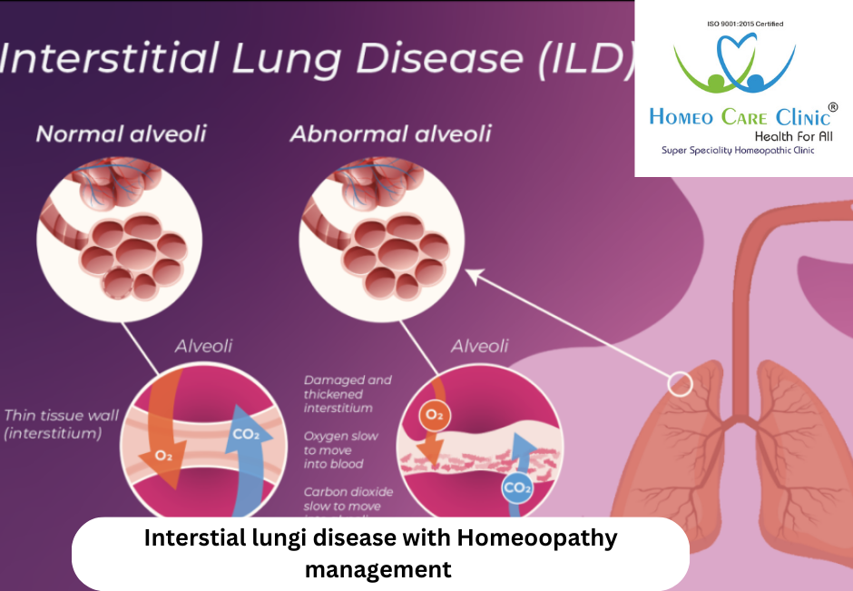 Interstitial Lung Disease: Causes, Symptoms, and Homeopathic Treatment