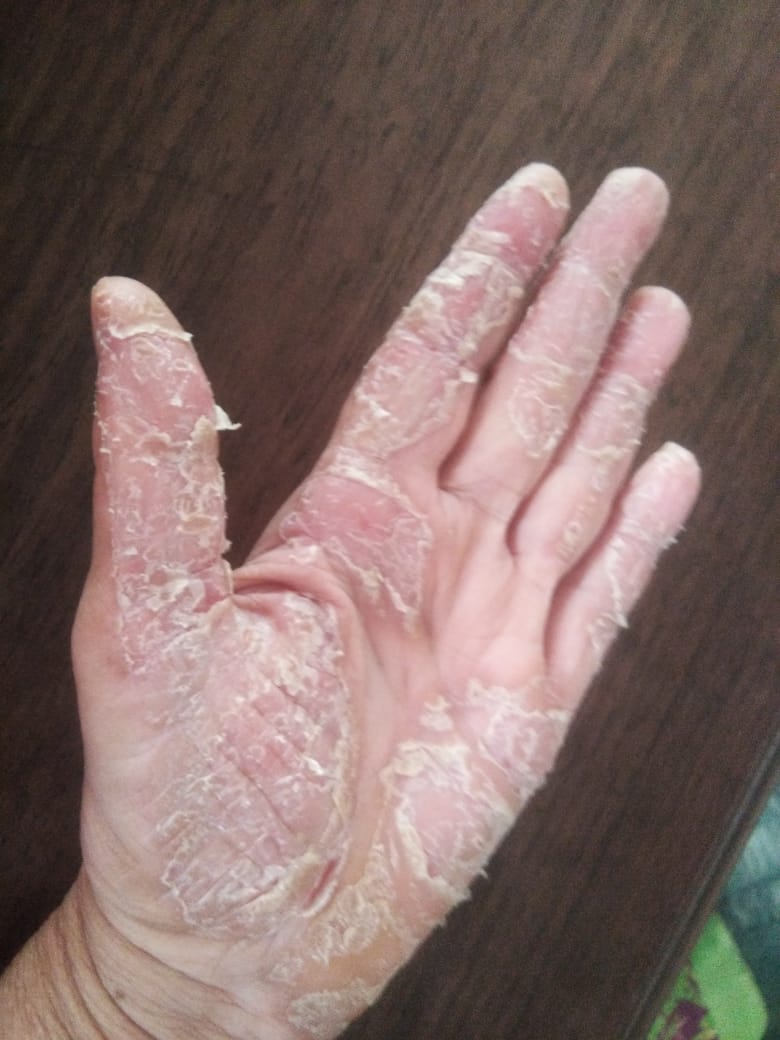 Psoriasis Palms Of Hands