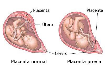 Image result for sinuses en la placenta