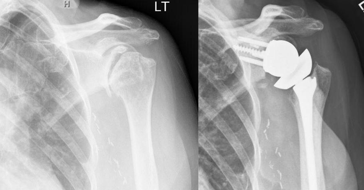 Reverse Total Shoulder Arthroplasty Without Bone Grafting for Glenoid ...