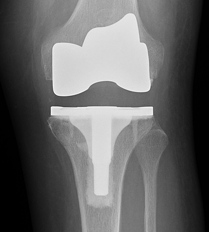 Anteroposterior (front-to-back view) X-ray of knee replacement implants.