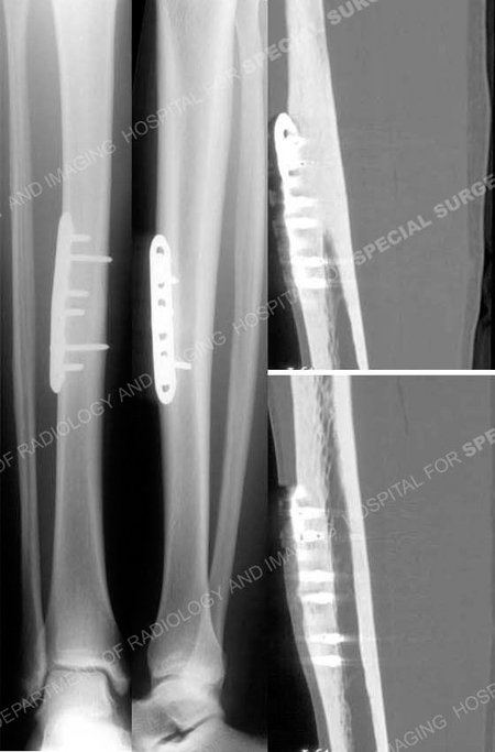 [DIAGRAM] Diagram Of Tibia Stress Fracture - MYDIAGRAM.ONLINE