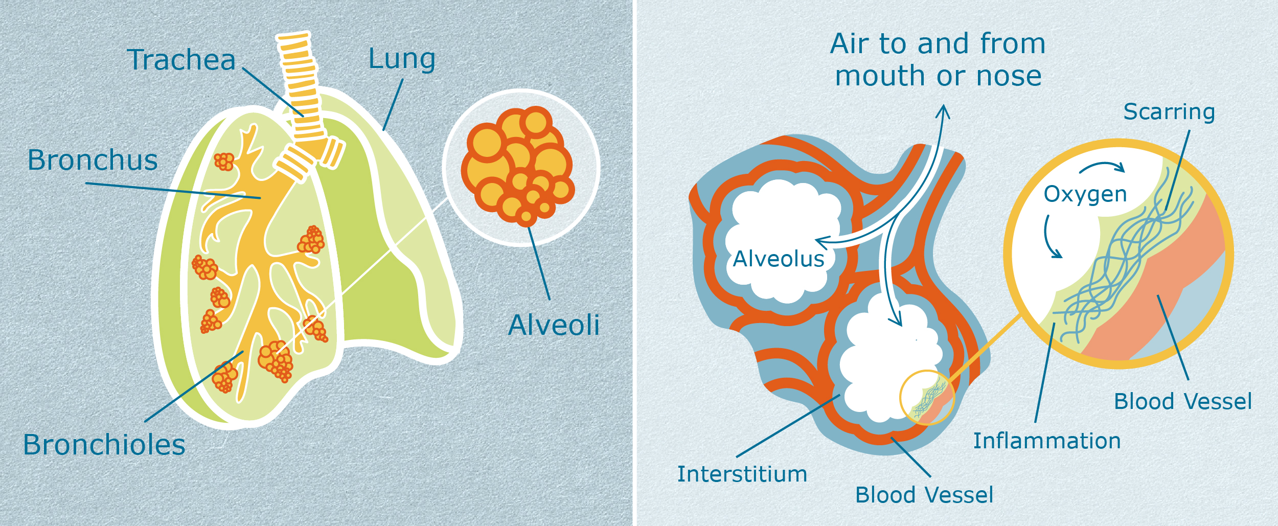 Interstitial Lung Disease I Guide On Types And Symptoms, 50% OFF