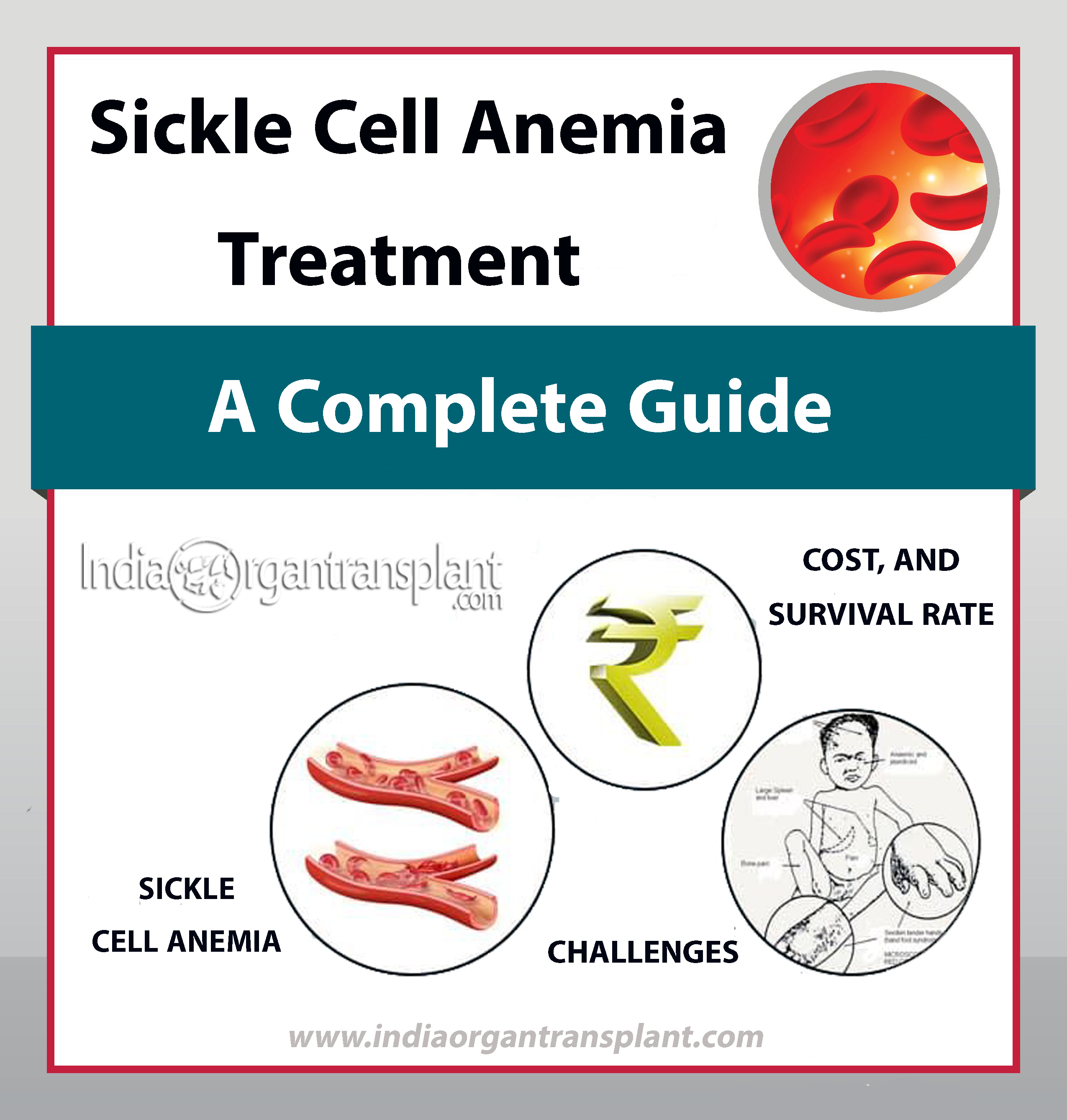 Sickle Cell Anemia Symptoms