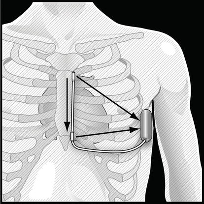 Subcutaneous Implantable Cardioverter Defibrillator