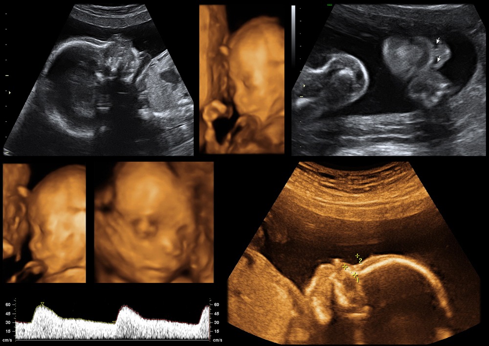 20 Weeks Pregnant 3d Ultrasound