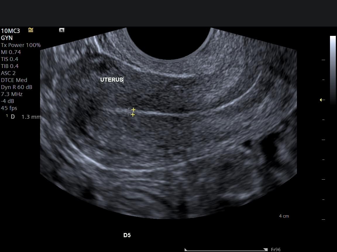 Uterus Ovaries And Sounds