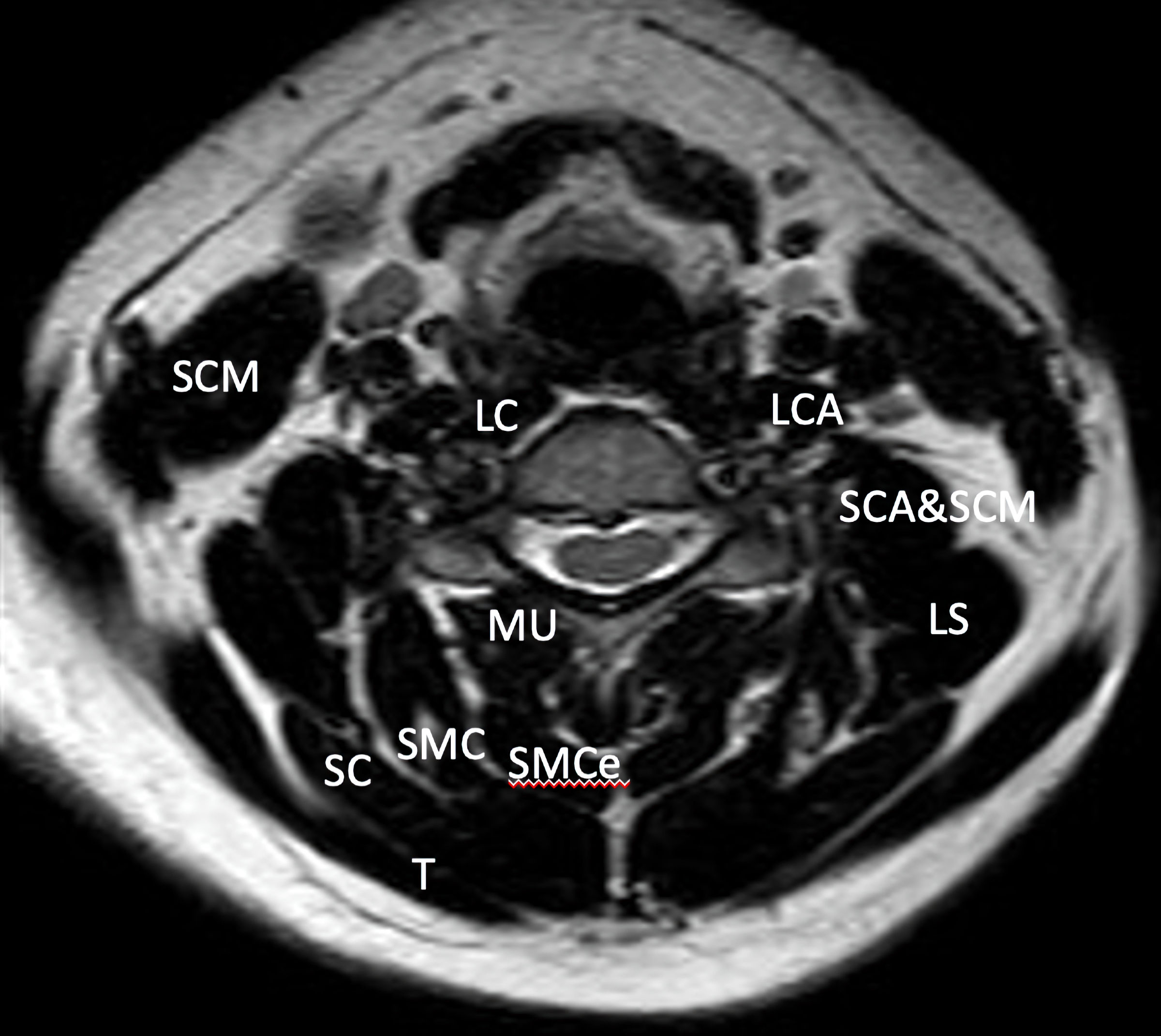 Mri Read Cervical Spine Axial View Anatomy Of Cervica - vrogue.co