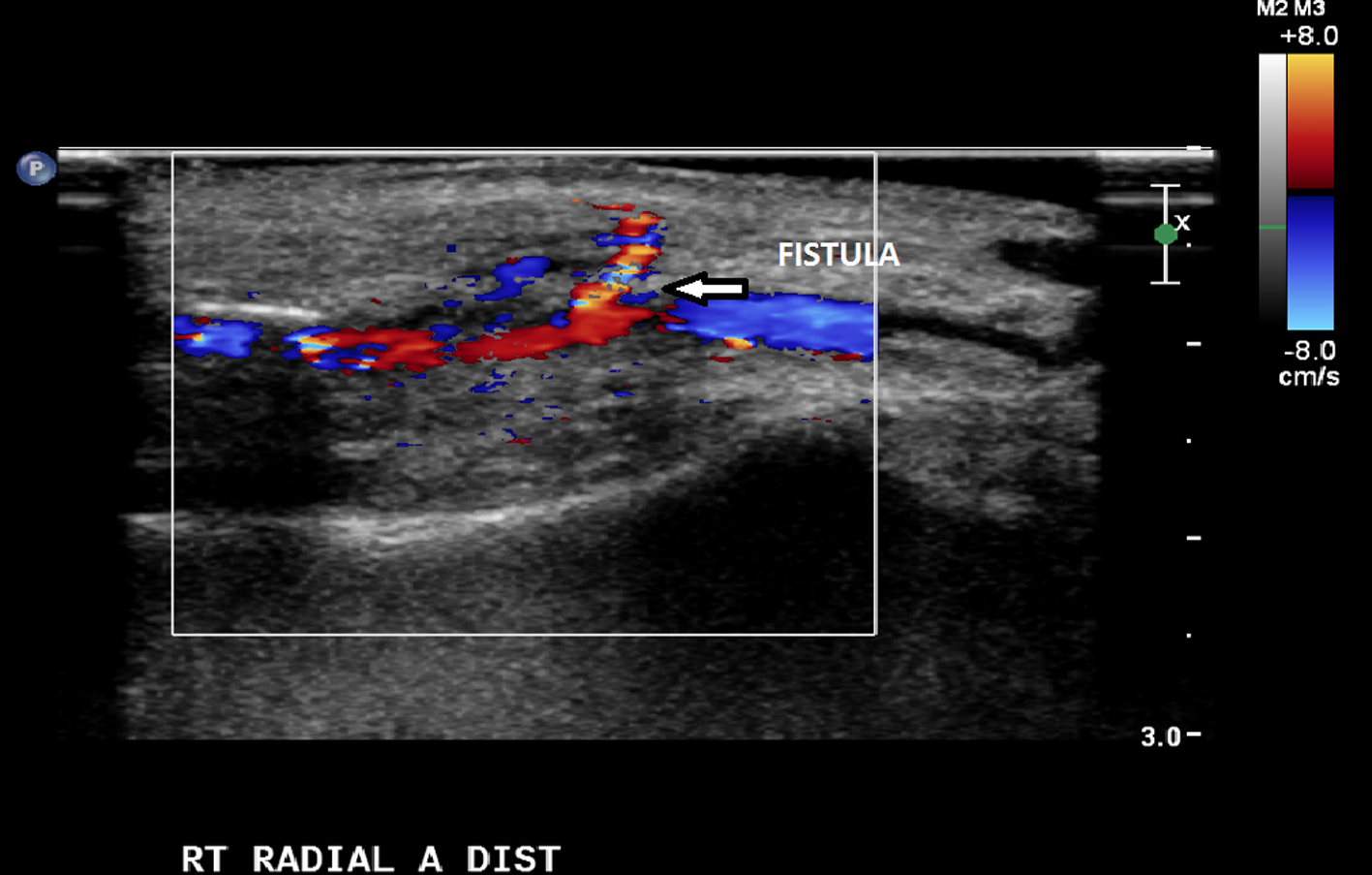 Arteriovenous Fistula as a Rare Early Complication of Transradial ...