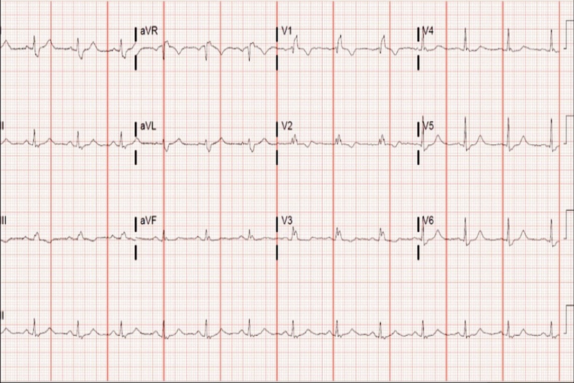 A 42 Year Old Male With An Abnormal Ecg Journal Of Urgent Care Medicine ...