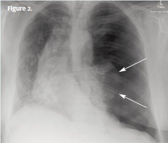 Sudden-Onset Left-Sided Chest Pain - Page 2 of 2 - Journal of Urgent ...