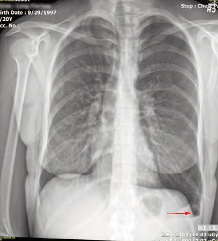 A 20-Year-Old Woman with Acute Chest Pain - Page 2 of 2 - Journal of ...