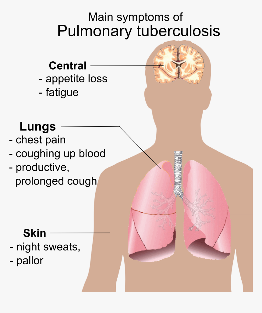 Pulmonary Tuberculosis Symptoms - Main Symptoms Of Pulmonary ...