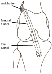 endobutton fixation