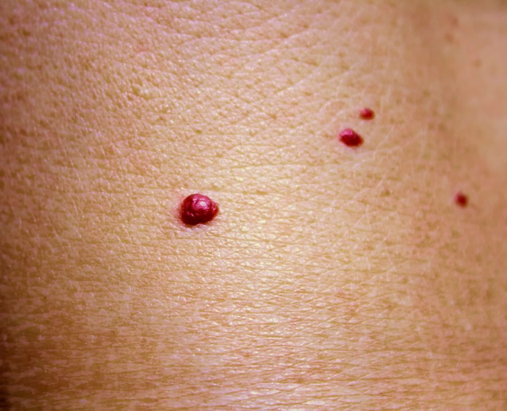 blood-spots-cherry-angioma-kumiega