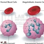 Megaloblastic Anemia