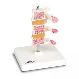 Deluxe Osteoporosis Model