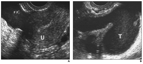 Image Diagnosis Tubo Ovarian Abscess With Hydrosalpin - vrogue.co