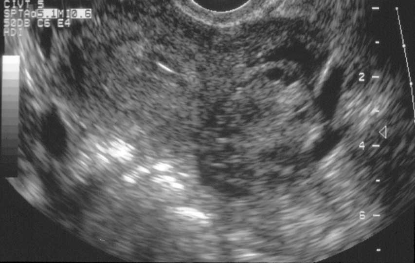 Ultrasound Of Pelvic Inflammatory Disease By Dr Gynob - vrogue.co