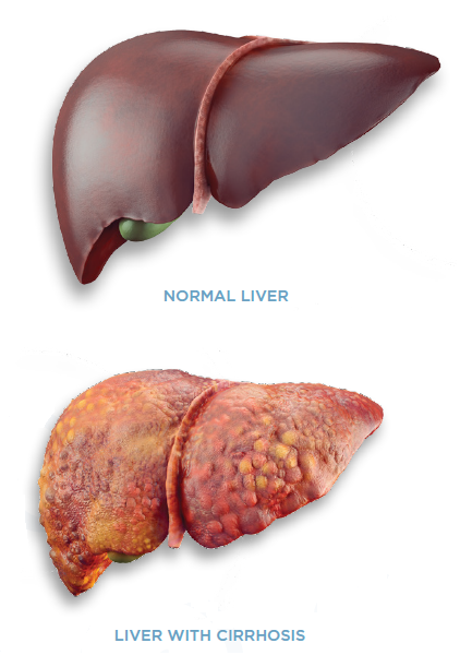 Alagille Syndrome - Canadian Liver Foundation