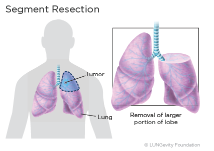 Surgery | LUNGevity Foundation