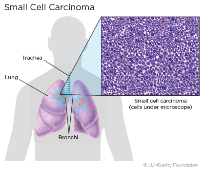 Small Cell Lung Cancer (SCLC) | LUNGevity Foundation