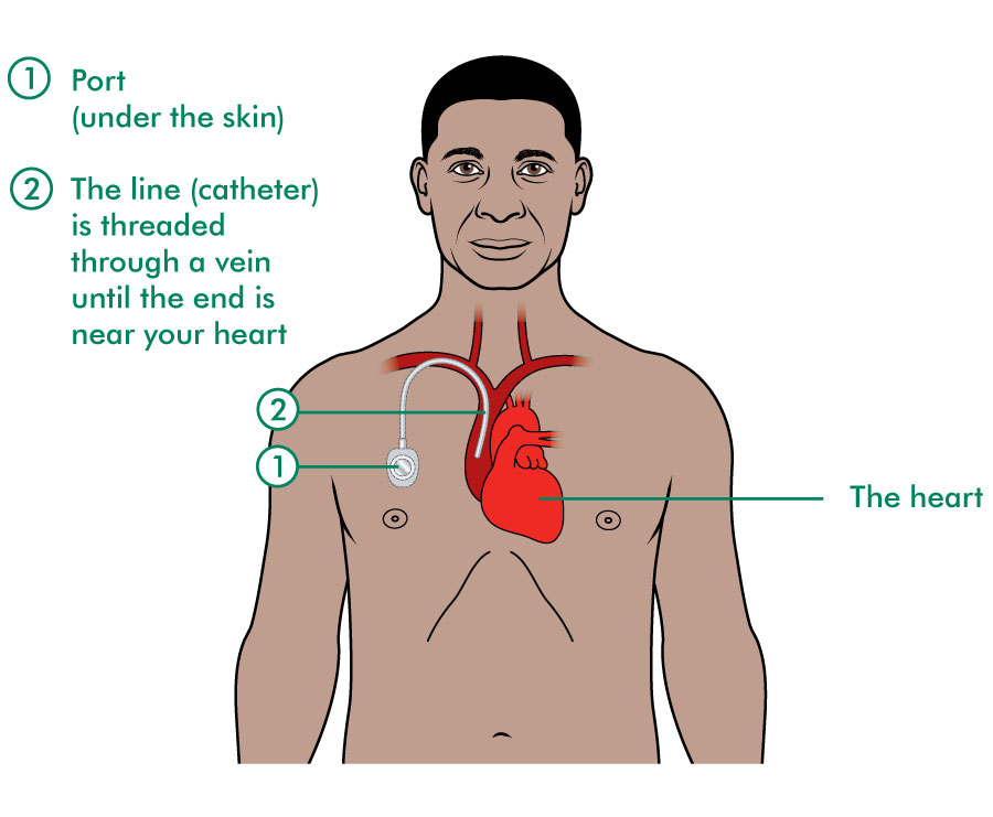 Types Of Port A Caths