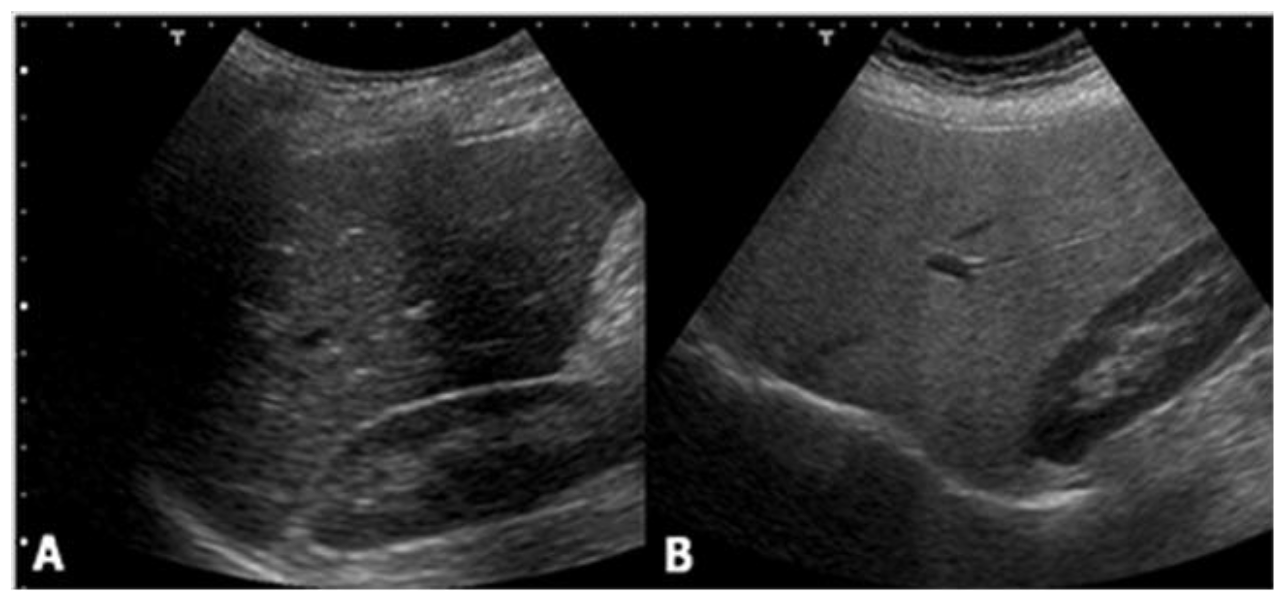 Normal Liver Ultrasound