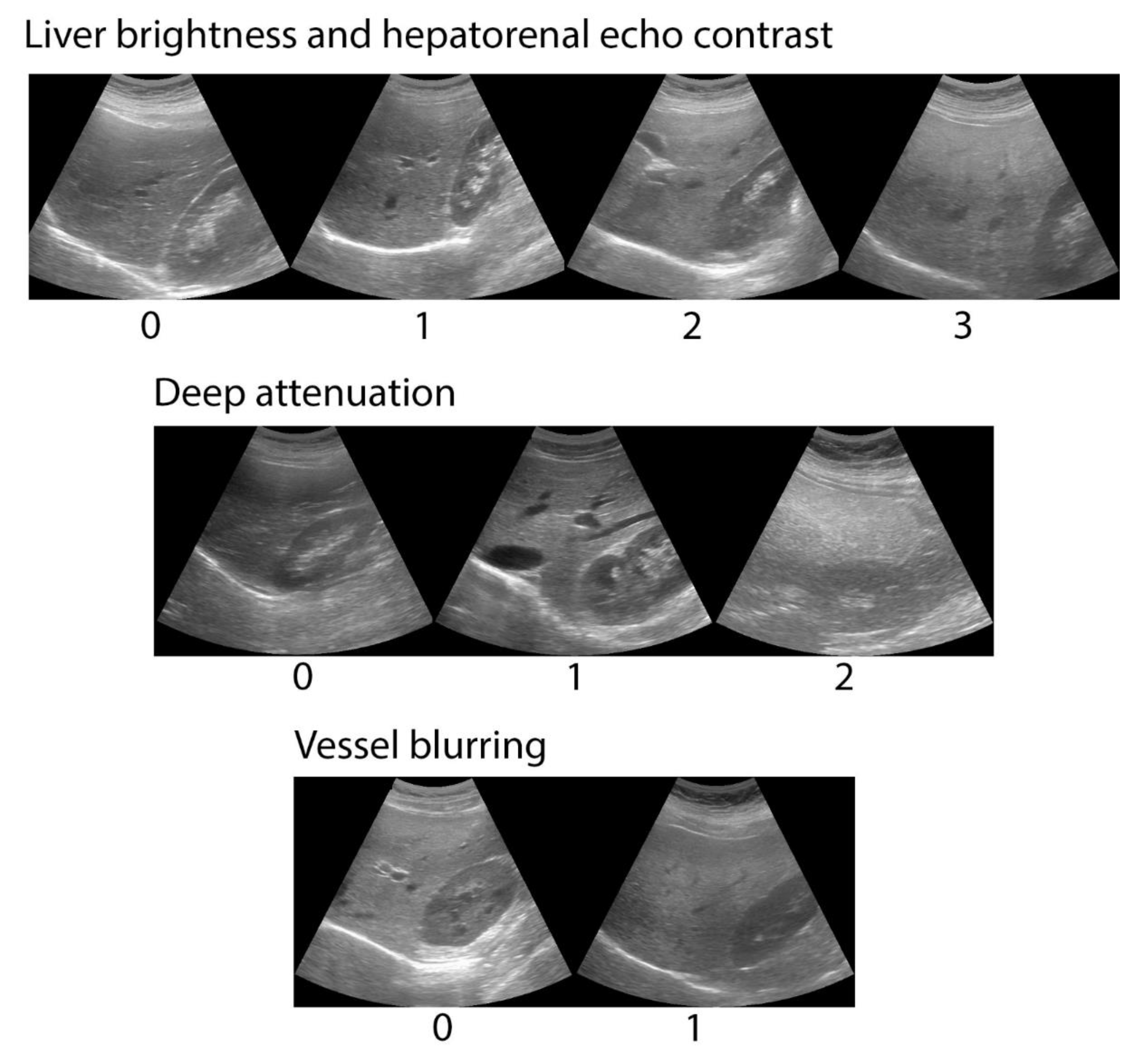 Fatty Liver Ultrasound Vs Normal Liver