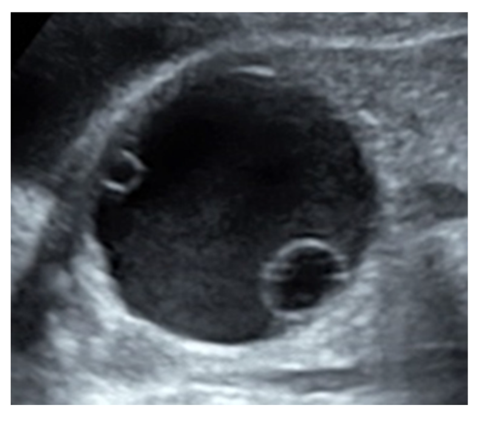 Functional Ovarian Cyst Ultrasound