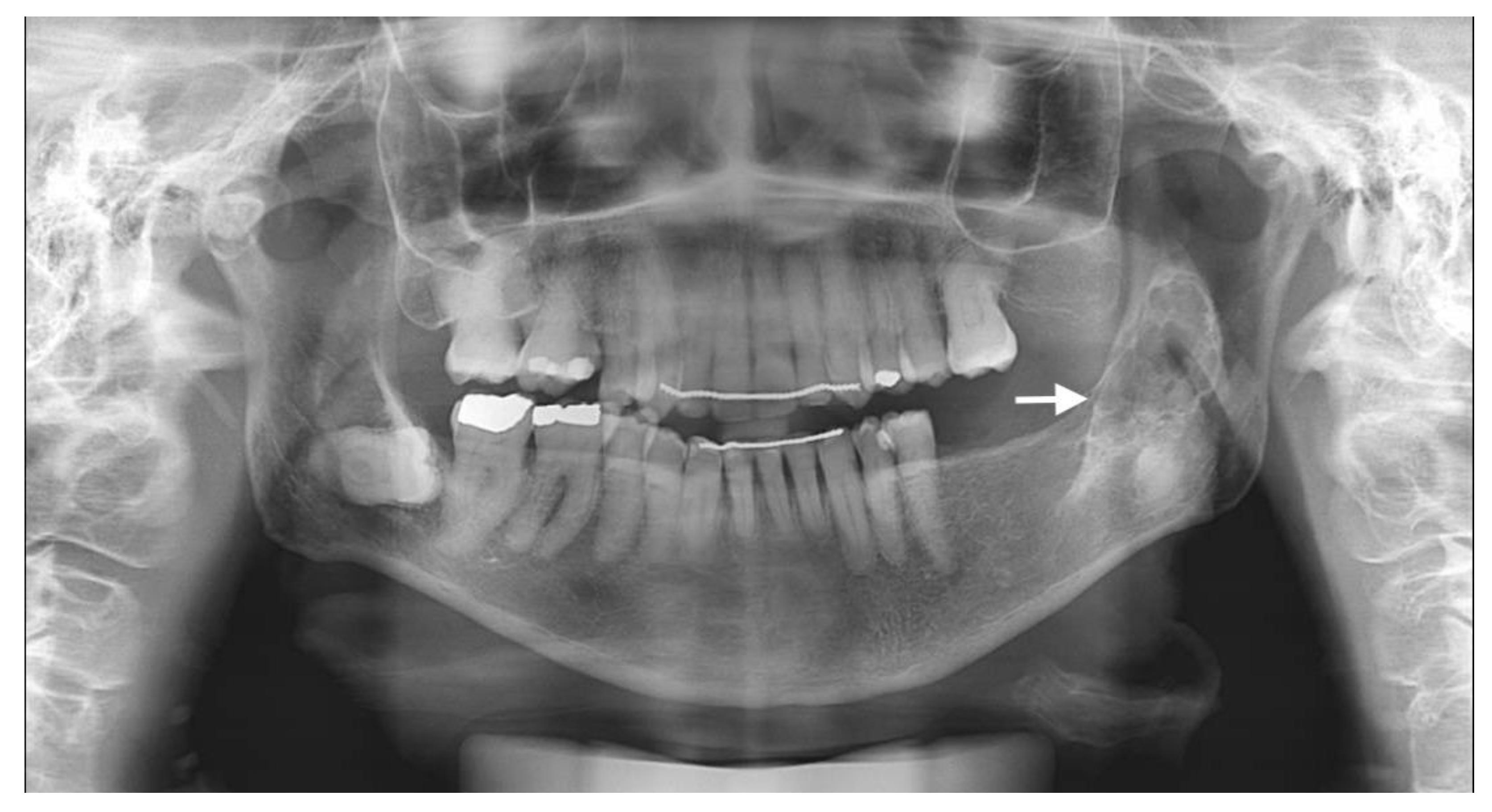 Calcifying Epithelial Odontogenic Tumor Radiography