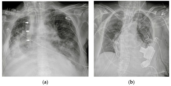 Diagnostics | Free Full-Text | Chest X-ray Interpretation: Detecting ...