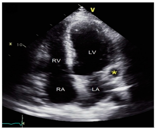 New Insights into the Pathophysiology of Coronary Artery Aneurysms