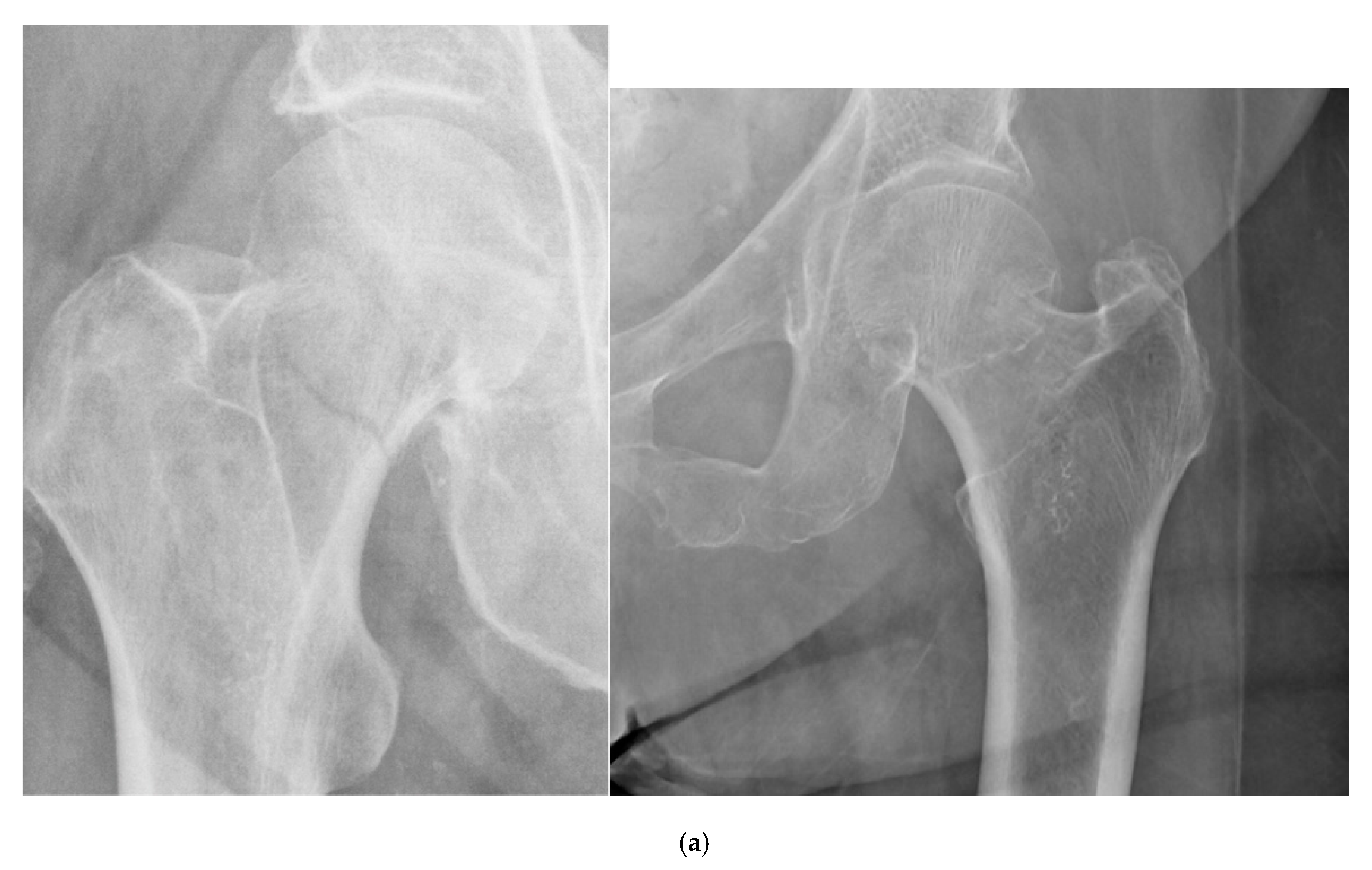 Left Femoral Neck Osteoporosis