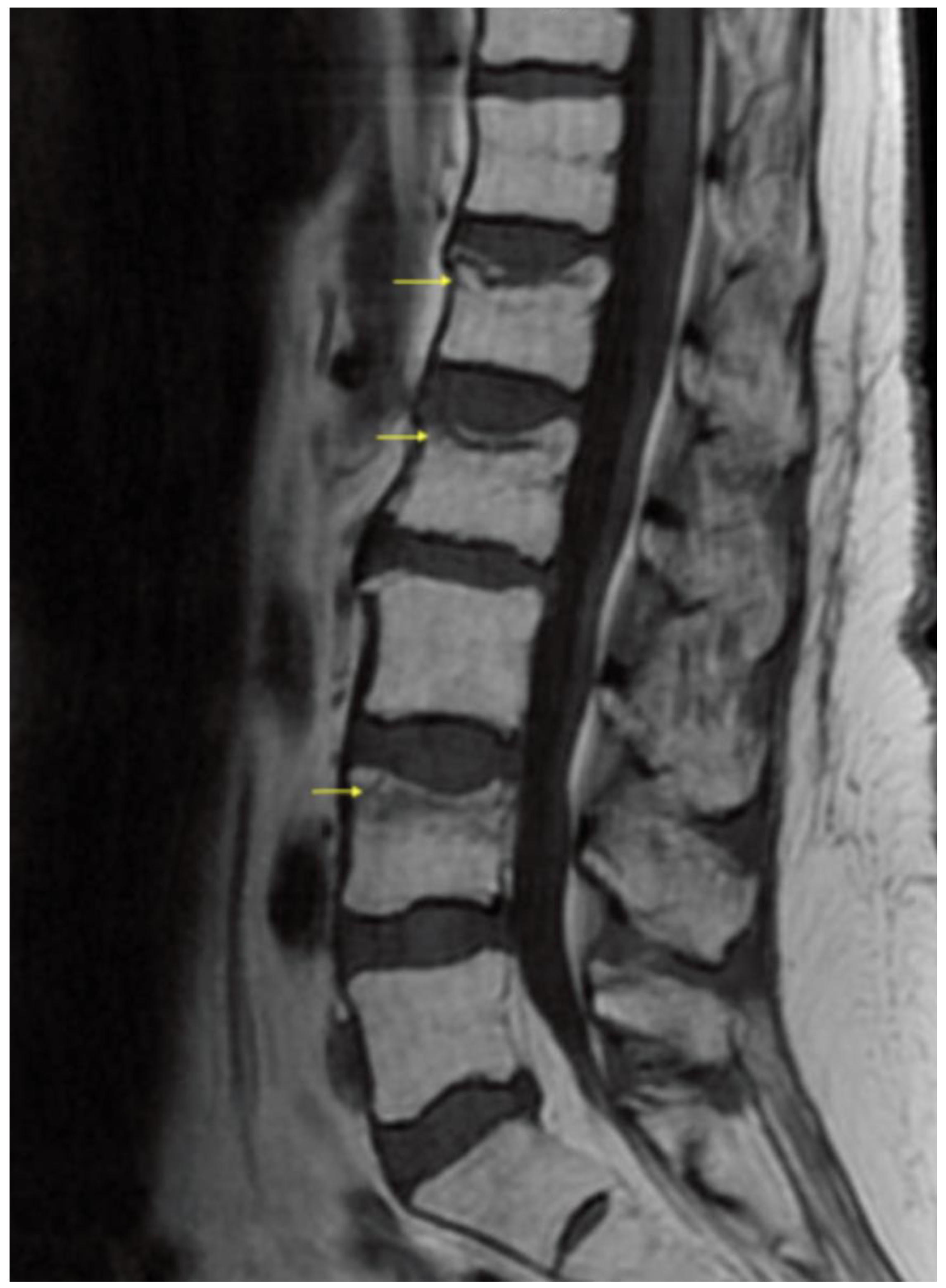 Compression Fracture