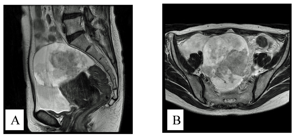 IJMS | Free Full-Text | A Case of Stage III c Ovarian Clear Cell ...