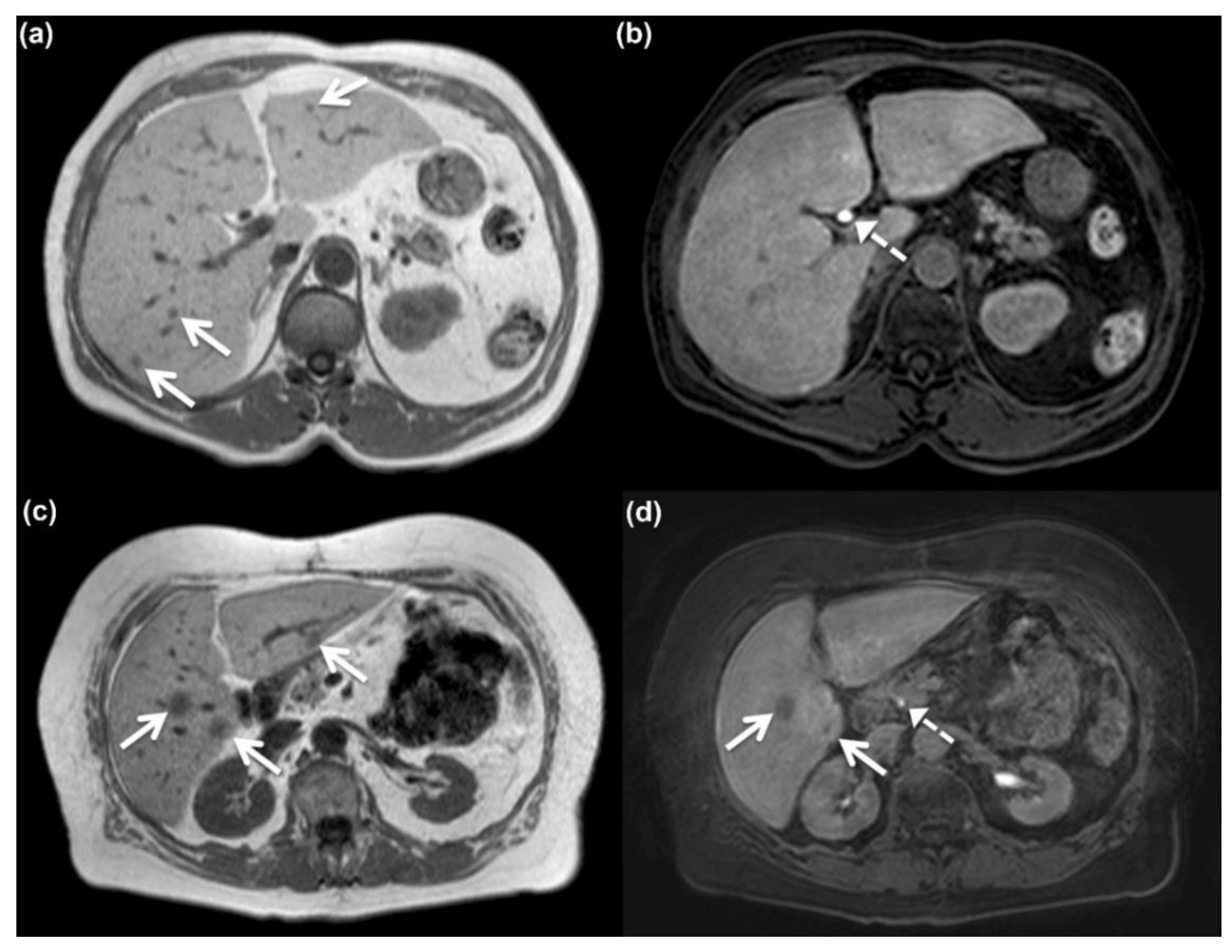 Fatty Liver Mri