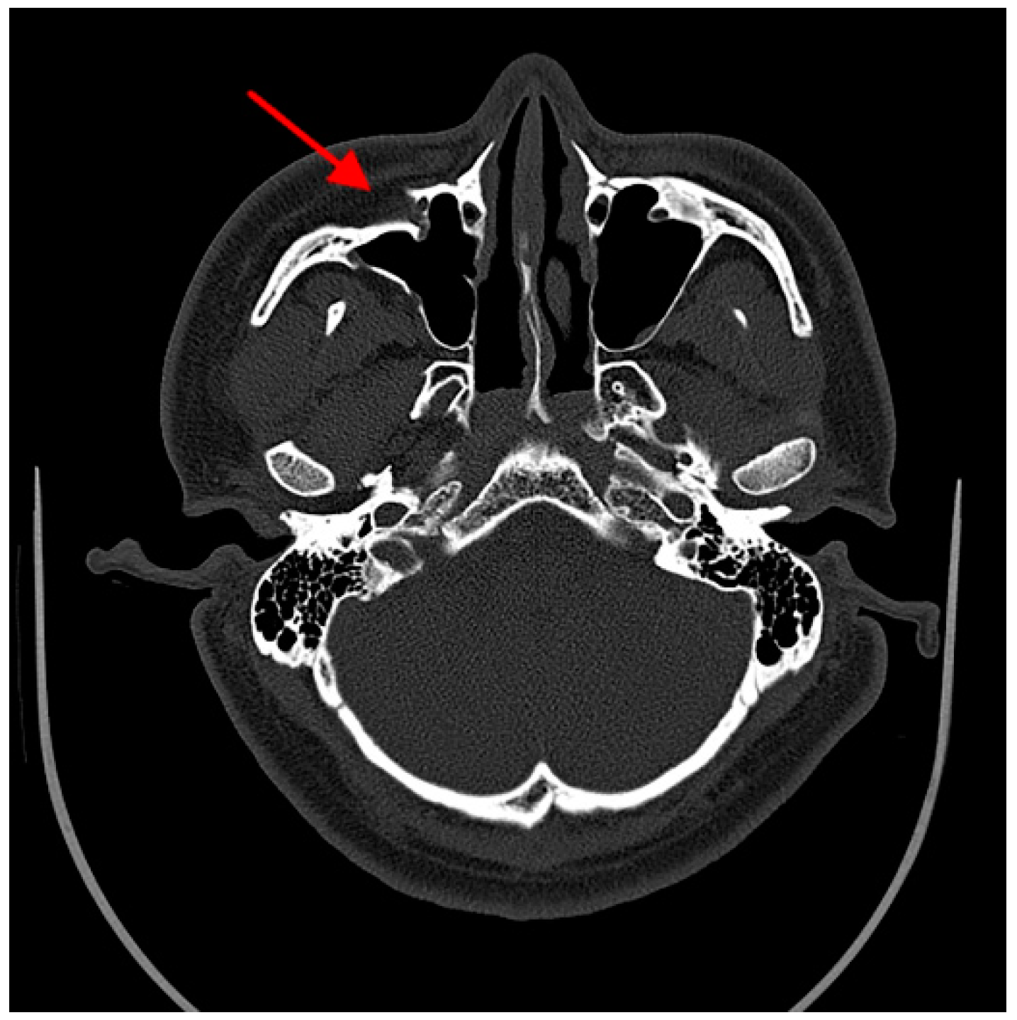 Maxillary Sinus Fracture And Hematoma | lupon.gov.ph