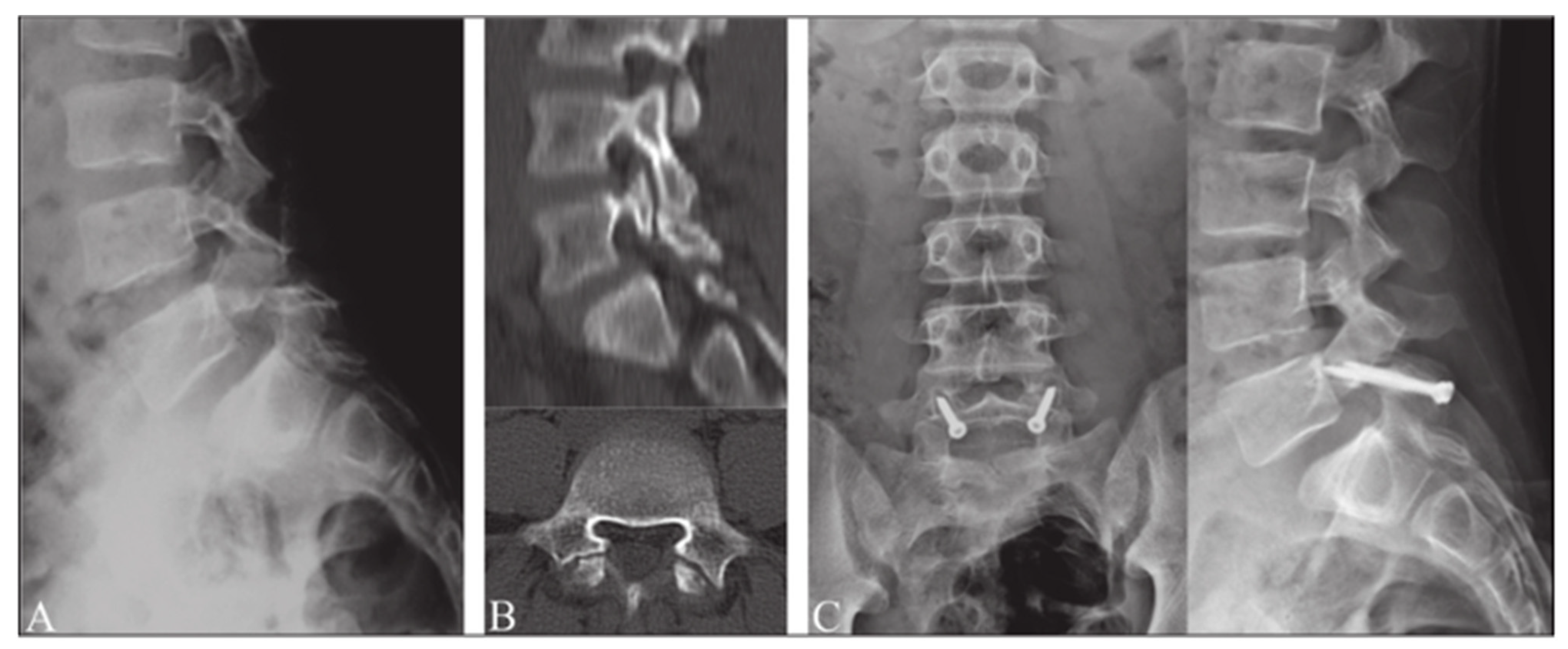 JCM | Free Full-Text | Pars Interarticularis Fractures Treated with ...