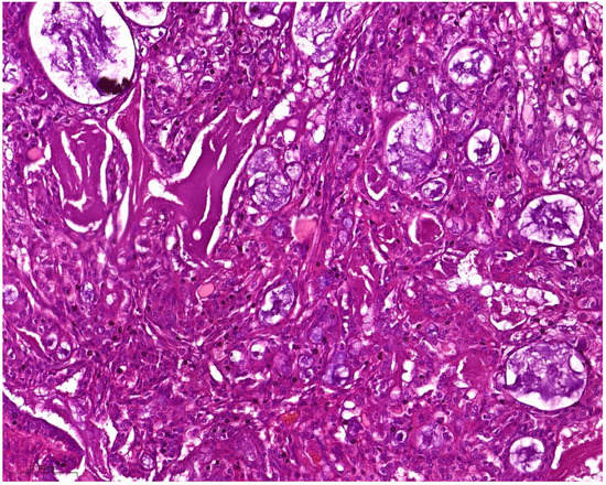 Activating Transcription Factor 1 (ATF1) Immunohistochemical Marker ...