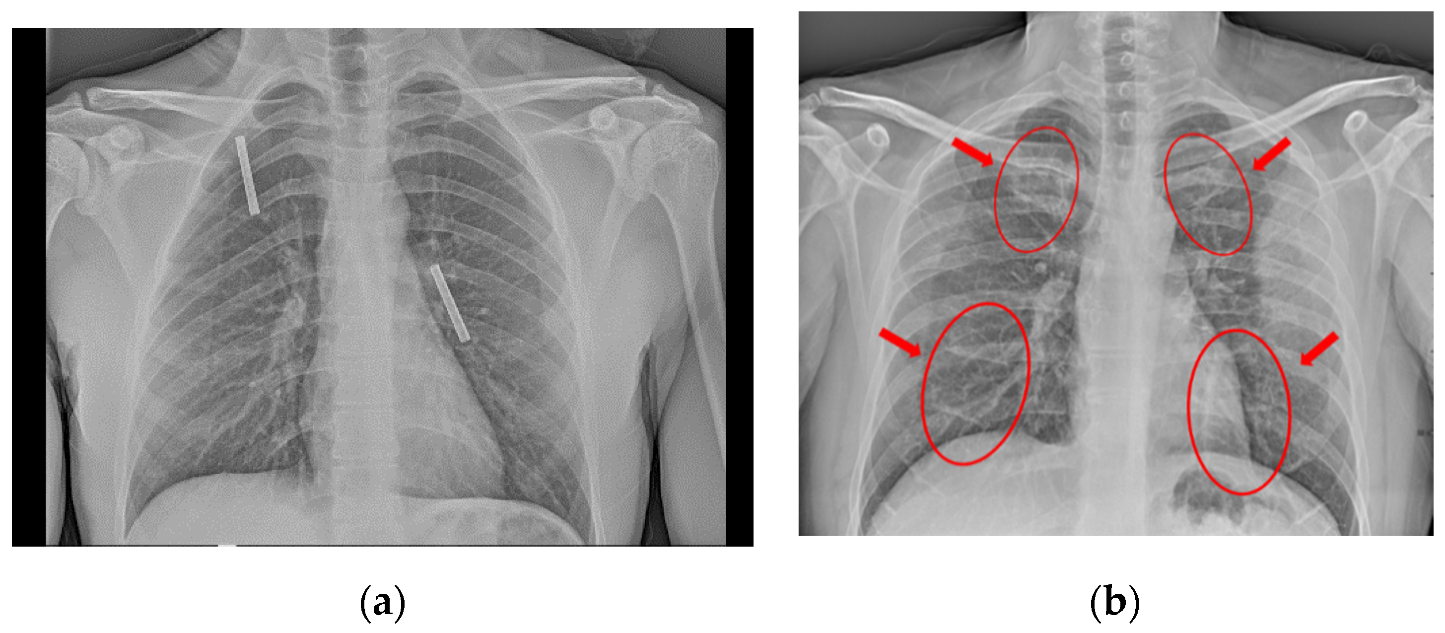 Chest Xray Pneumonia