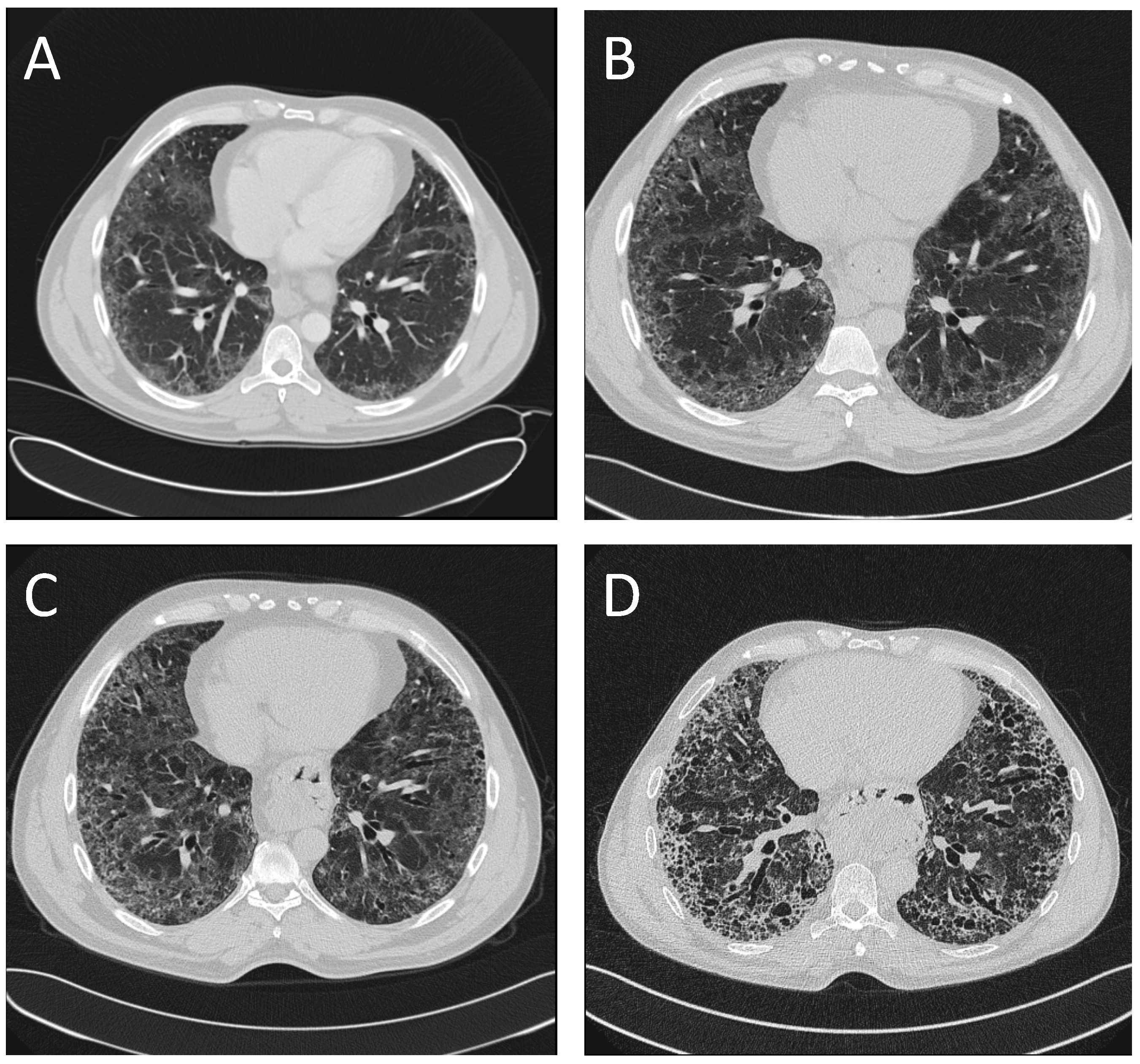 Idiopathic Pulmonary Fibrosis Honeycomb image.