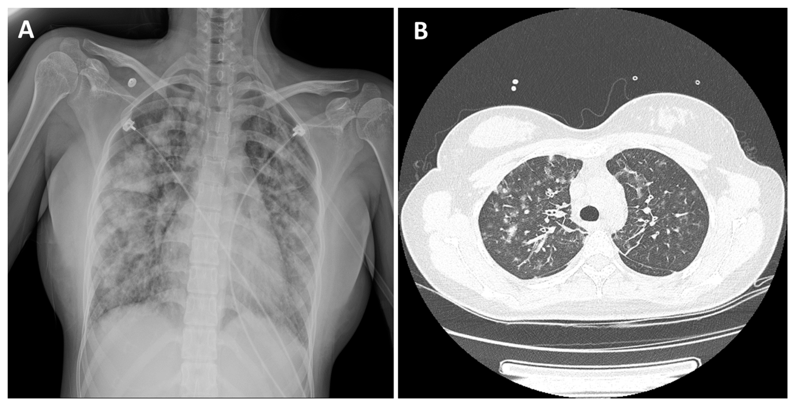 Mistaken For Lung Cancer Pneumonia