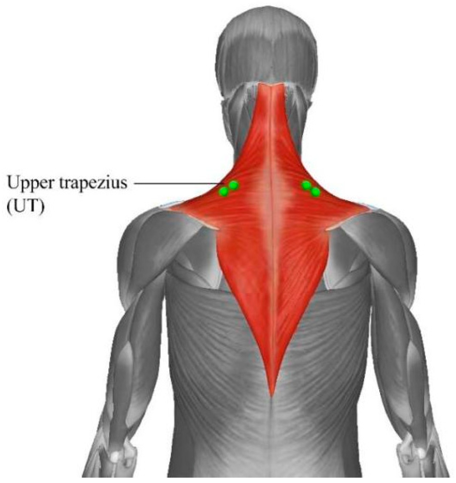 Trapezius Muscle Pain